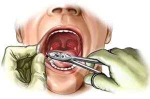 Alveolita după dinte - Tratamentul