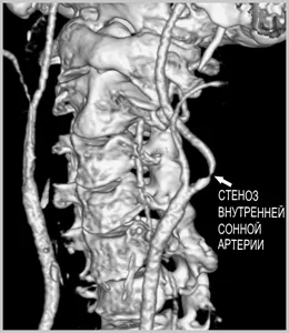 Carotis atherosclerosis és az ischaemiás stroke tüneteinek, ischaemia, az artéria vaszkuláris