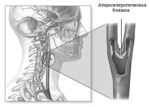 Атеросклеротичната стеноза на сънната артерия като причина за инсулт - сибирски Медицински