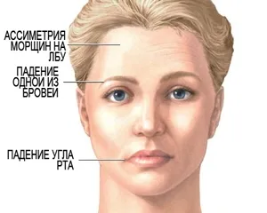 aterosclerozei carotidiene si simptomele accident vascular cerebral ischemic, tratamentul ischemiei, vasculare ale arterelor