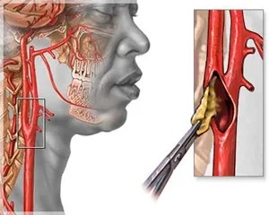 aterosclerozei carotidiene si simptomele accident vascular cerebral ischemic, tratamentul ischemiei, vasculare ale arterelor