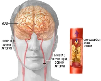 Carotis atherosclerosis és az ischaemiás stroke tüneteinek, ischaemia, az artéria vaszkuláris