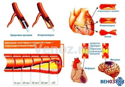 Atherosclerosis az aorta a szív a hasi aorta, szívkoszorúerek