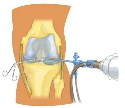 Artroszkópos eltávolítását a meniszkusz a térdízület, a hatások és helyreállítási