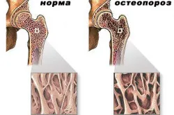 Болки кости на крака причини