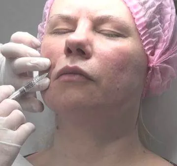 Биоревитализация лицеви хиалуронова киселина снимка, коментари