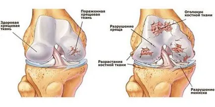 Болки в колената, когато клекнал и изгрева - какво да правя