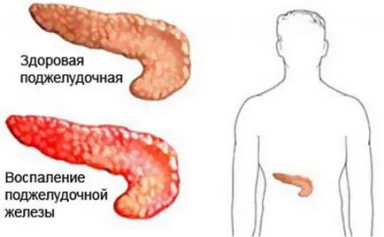 A betegség tünetei a hasnyálmirigy, a megelőzés, diéta