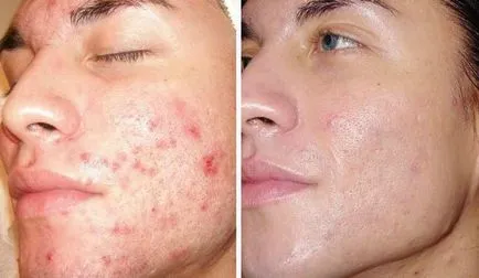 pielea fetei Bumpy cauze si tratament, sfaturi foto si video dermatologi