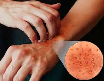 Decât pentru a trata eczeme pe mâini și ce unguente decât este periculos
