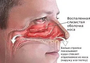 Ce înseamnă hiperemia mucoasei membranelor mucoase nazale inflamate ale nasului și a terapiei, restructurarea