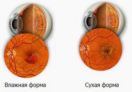 Tshrd retina - száraz és exszudatív (nedves) formái okok, tünetek és a kezelés (injekció és lézer)