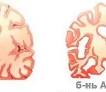 Differenciál diagnózis az Alzheimer-kór és a vaszkuláris dementia