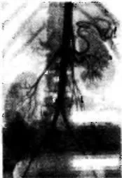 диагноза Nephroptosis