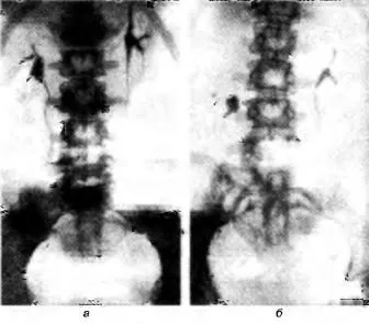 diagnosticul Nephroptosis