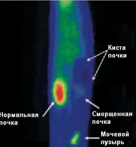 Диагностика на бъбречните кисти, уролога