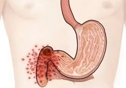 Дуоденит отколкото лечението на различни форми на заболяването