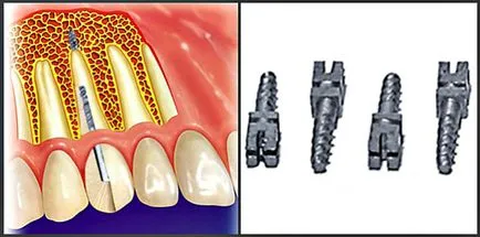 Endodontic stabilizate implanturi și ce beneficii