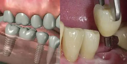 Endodontic stabilizate implanturi și ce beneficii