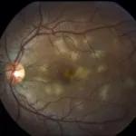 Хипертония симптоми и лечение ретинопатия