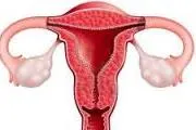 hiperplazie endometrială după chiuretaj