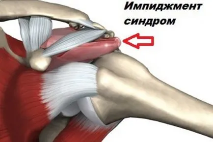 Ударно синдром на раменна става лечение и упражнения