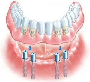 Зъбните импланти в 1 дни - как да се направи цени