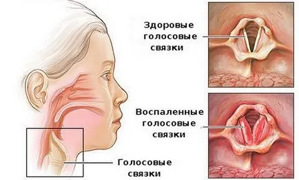 Кашлица с ангина и болки в гърлото какво да правя, какво и как за лечение