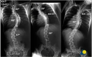 Jóga a scoliosis 1, 2, 3 fok, a testmozgás