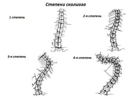 Jóga a scoliosis 1, 2, 3 fok, a testmozgás