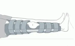 Както шина костни фрактури на тибията правила и съвети