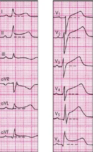 Hogyan lehet megkülönböztetni az EKG szívroham egyéb patológia