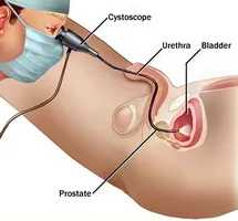 Care este cel mai eficient tratament baza de prescriptie de plante prostatita acolo