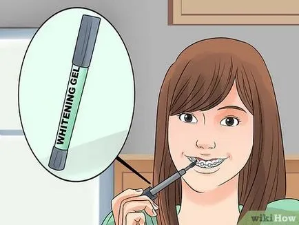 Hogyan fehéríti a fogakat jelenlétében fogászati ​​nadrágtartó