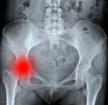 Coxarthrosis - hip arthrosis