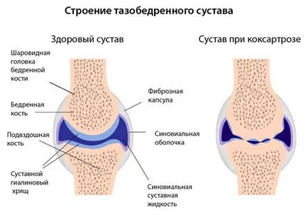 Coxarthrosis - hip arthrosis