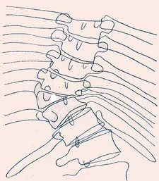 Kyphoscoliosis на гръбнака на гръдния кош, на причините за болестта, лечението