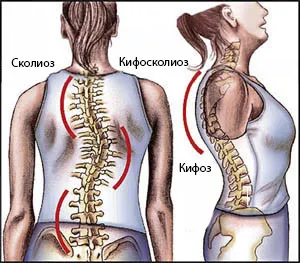 Kyphoscoliosis на гръбнака на гръдния кош, на причините за болестта, лечението