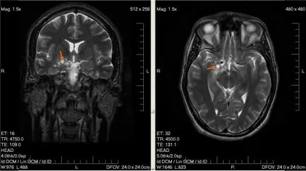 agyi ciszta fotók, MRI képek, a leírás az esetek