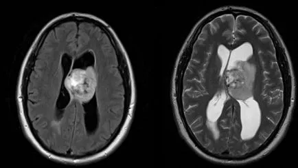 agyi ciszta fotók, MRI képek, a leírás az esetek