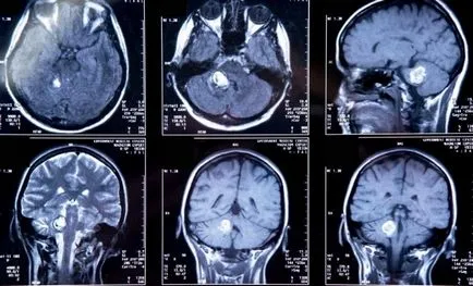 мозъчни киста на снимки, ядрено-магнитен резонанс на изображения, описанието на случая