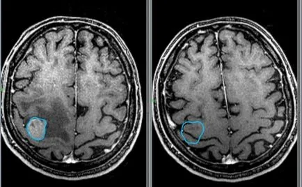 agyi ciszta fotók, MRI képek, a leírás az esetek