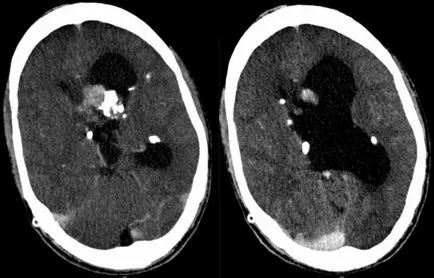 agyi ciszta fotók, MRI képek, a leírás az esetek