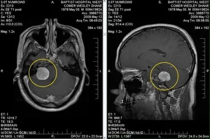 agyi ciszta fotók, MRI képek, a leírás az esetek