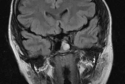 agyi ciszta fotók, MRI képek, a leírás az esetek