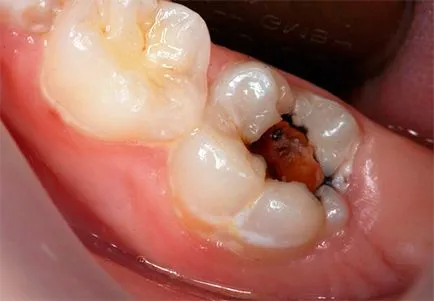 Osztályozás pulpitises azok típusú és alakú (BNO 10, Vinogradova és mtsai