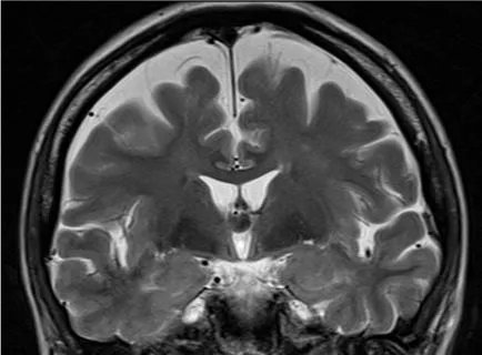 agyi ciszta fotók, MRI képek, a leírás az esetek