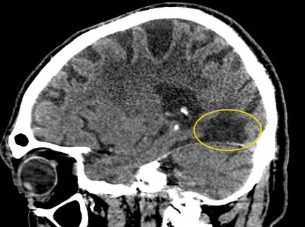 agyi ciszta fotók, MRI képek, a leírás az esetek