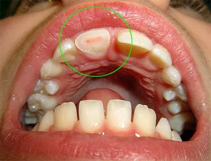 Clasificarea pulpitises tipurile lor și forme (ICD 10, Vinogradova et al