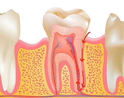 Класификация pulpitises техните видове и форми (ICD 10, Vinogradova сътр